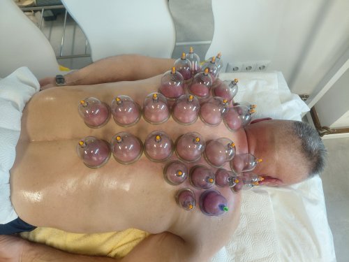 Cupping masaža